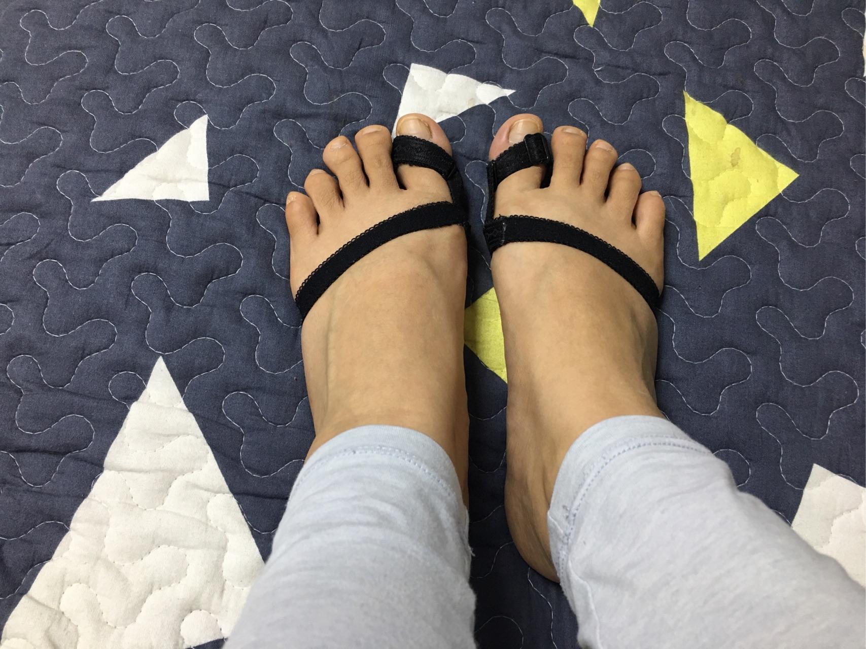 女生脚趾拇外翻是什么样体验? - 知乎