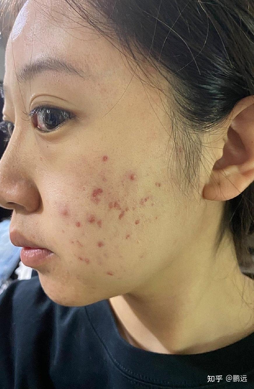 有没有比较管用的祛痘印产品? - 知乎