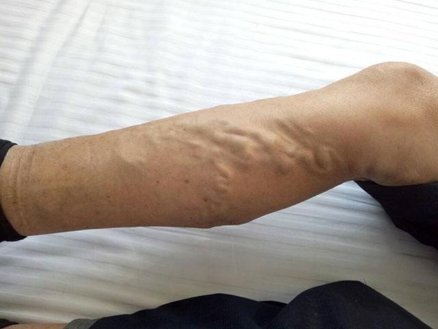 静脉曲张并不可怕可怕的是无知