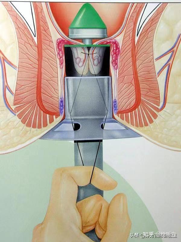 痔疮概念图图片