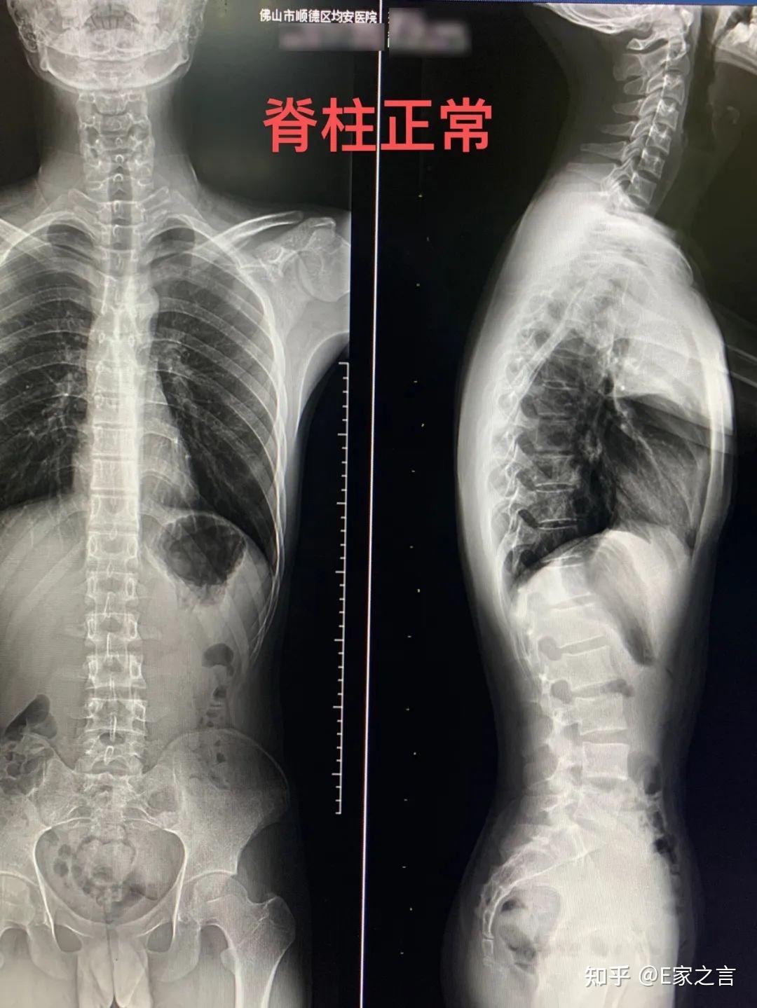 胸腰椎侧位拍摄可以一次拍摄吗