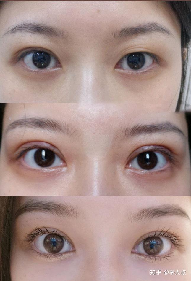 肿眼泡抽脂眼皮会松弛吗? - 知乎