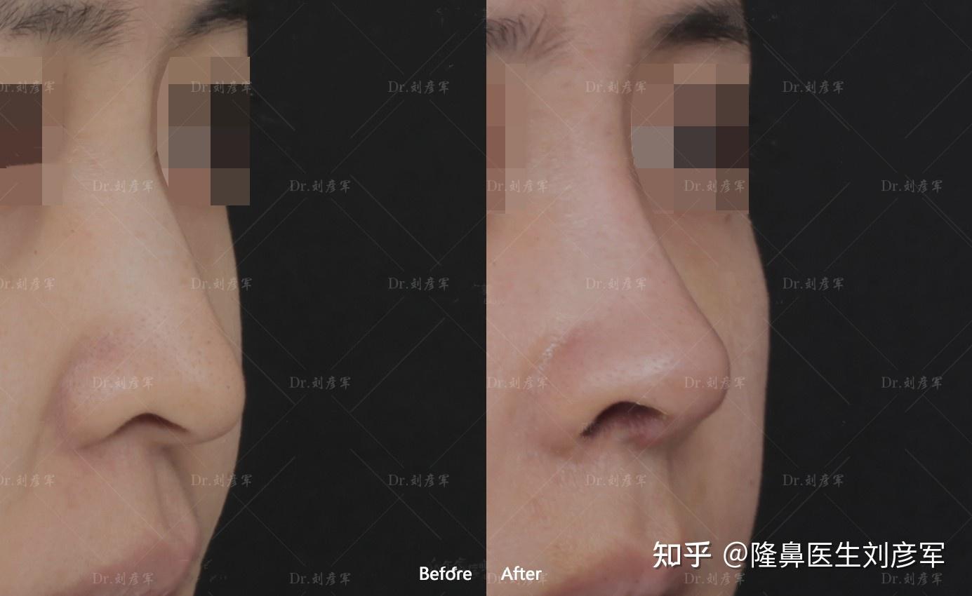 我想做一个鼻综合,鼻子很塌,不好看。? - 知乎