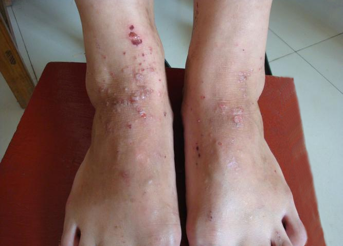 足部湿疹,水疱型脚气,怎么分辨