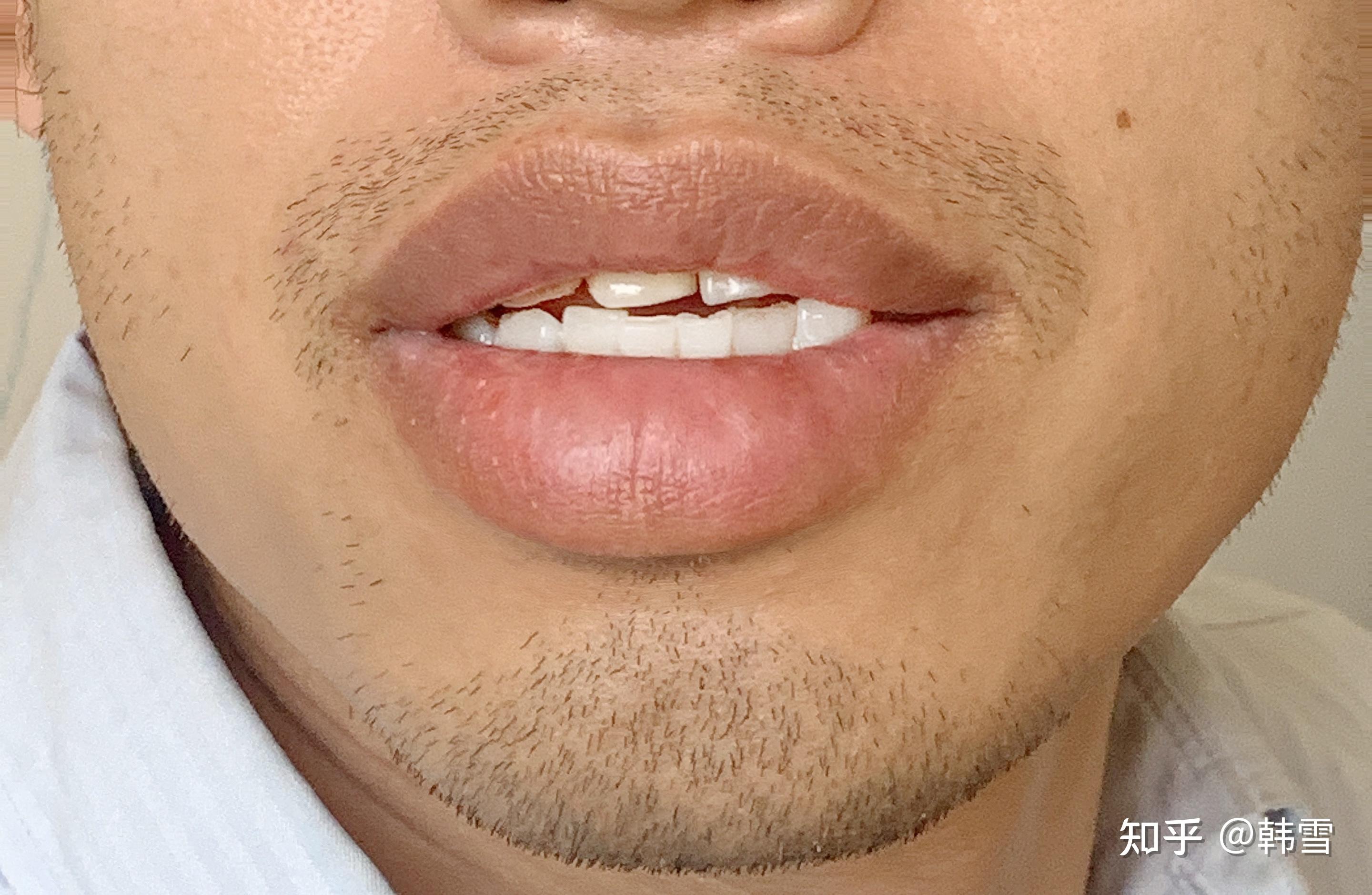 嘴唇变乌? - 知乎