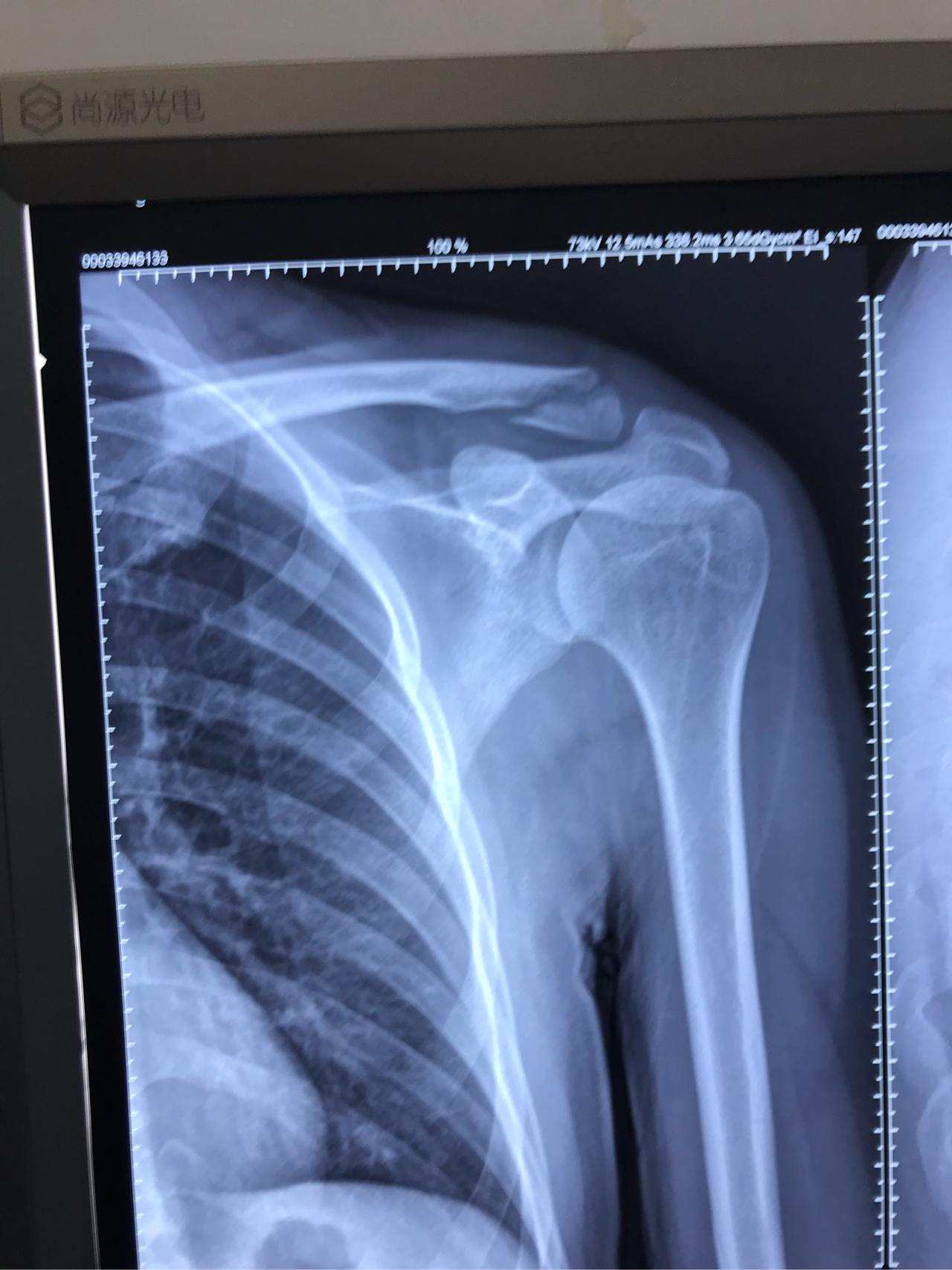 锁骨远端骨折片子如图求给意见欢迎讨论