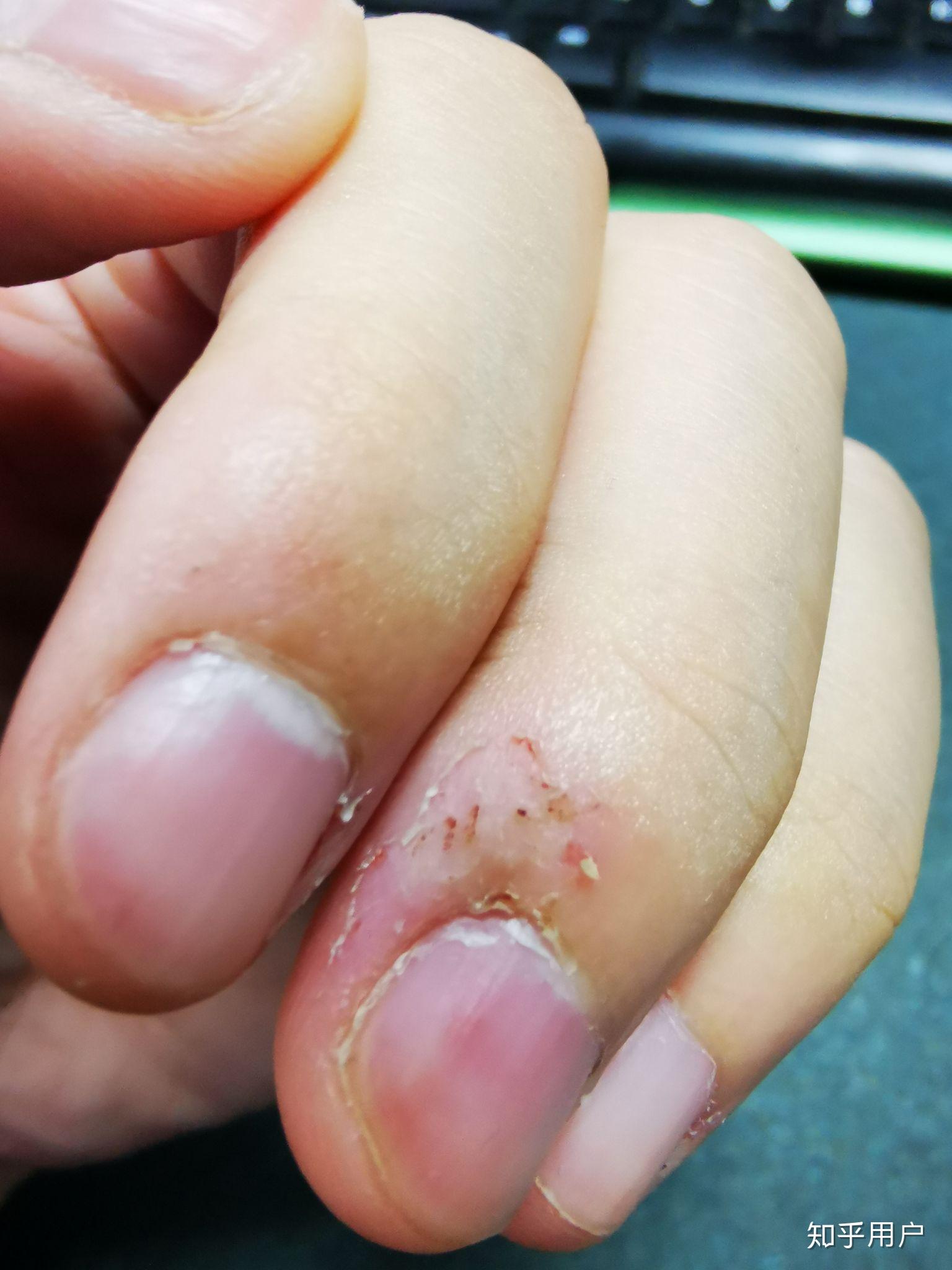 咬手皮是一种怎样的心理? - 知乎