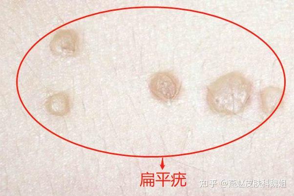 如何辨别 “脂肪粒、汗管瘤、扁平疣”？ - 知乎