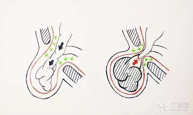 在孩子40天时发现了左腹股沟疝气请问我们要怎么护理才能让疝气自愈