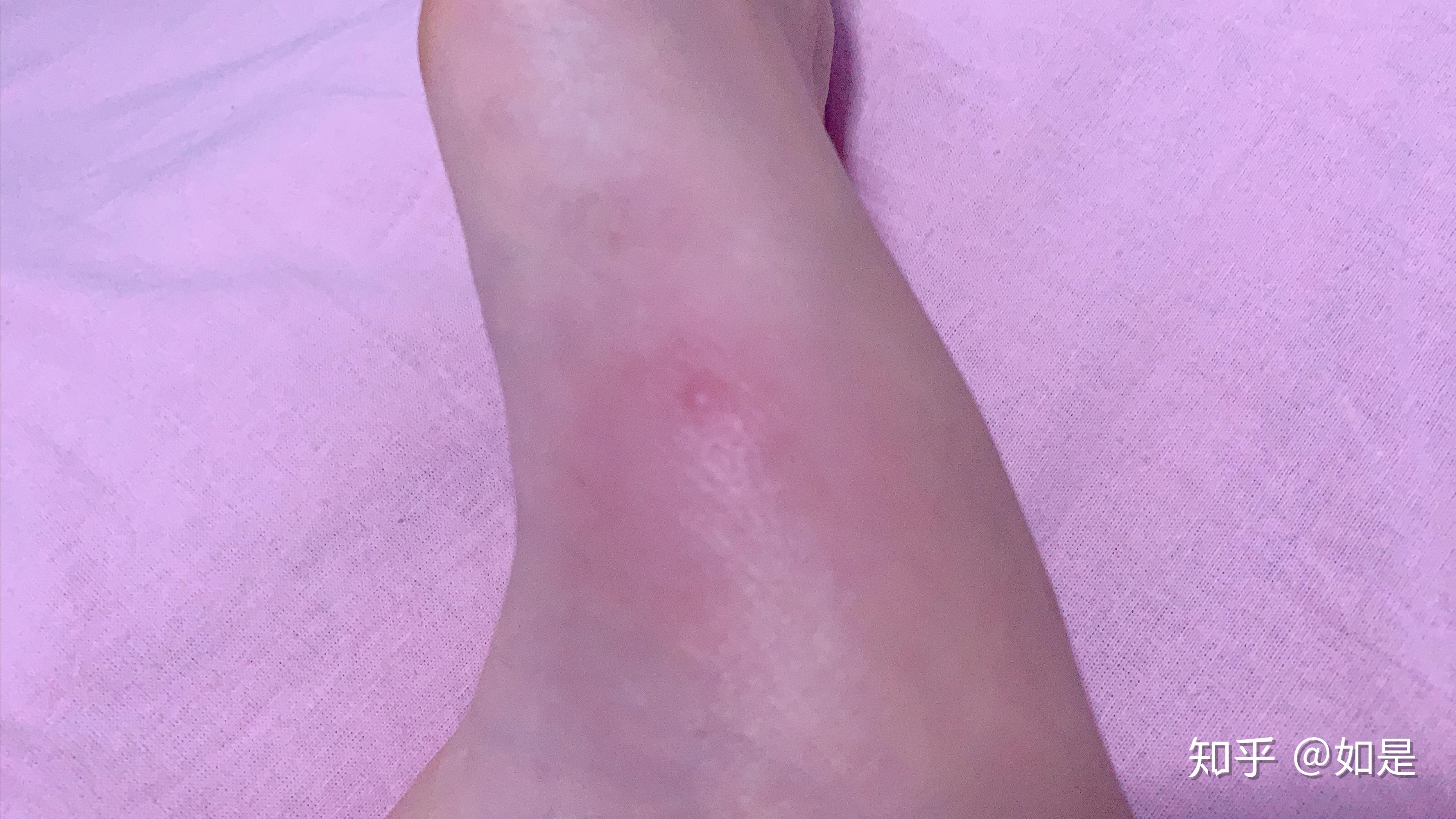 被毒蚊子咬了肿了很大一个包还很硬之后肿的包上面起了水泡挑破之后第