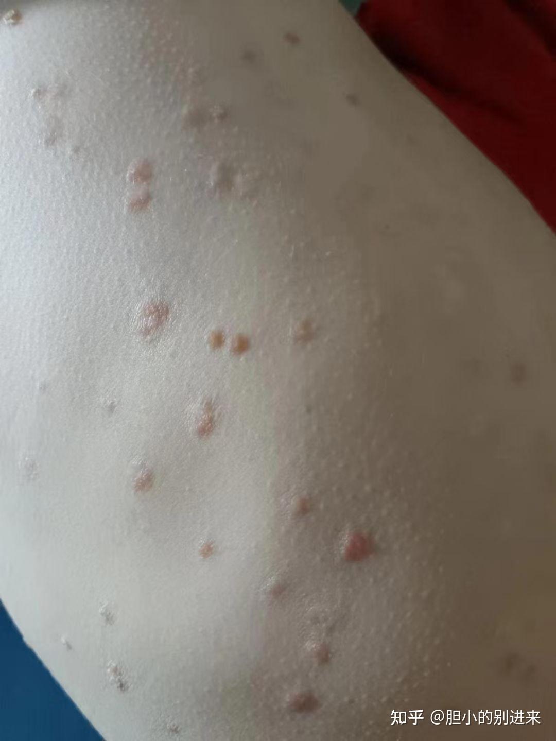 银屑病初期有什么迹象?