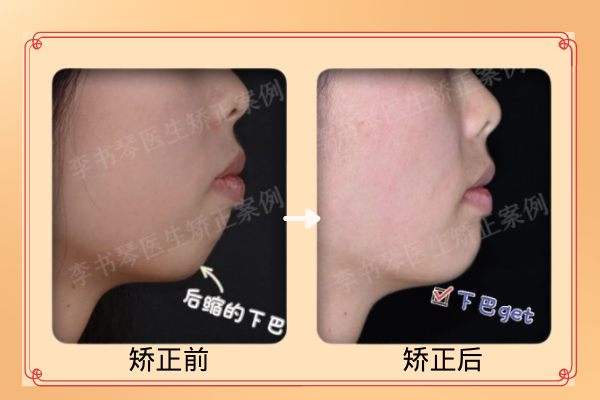 重庆牙齿矫正下颌后缩矫正能达到什么效果