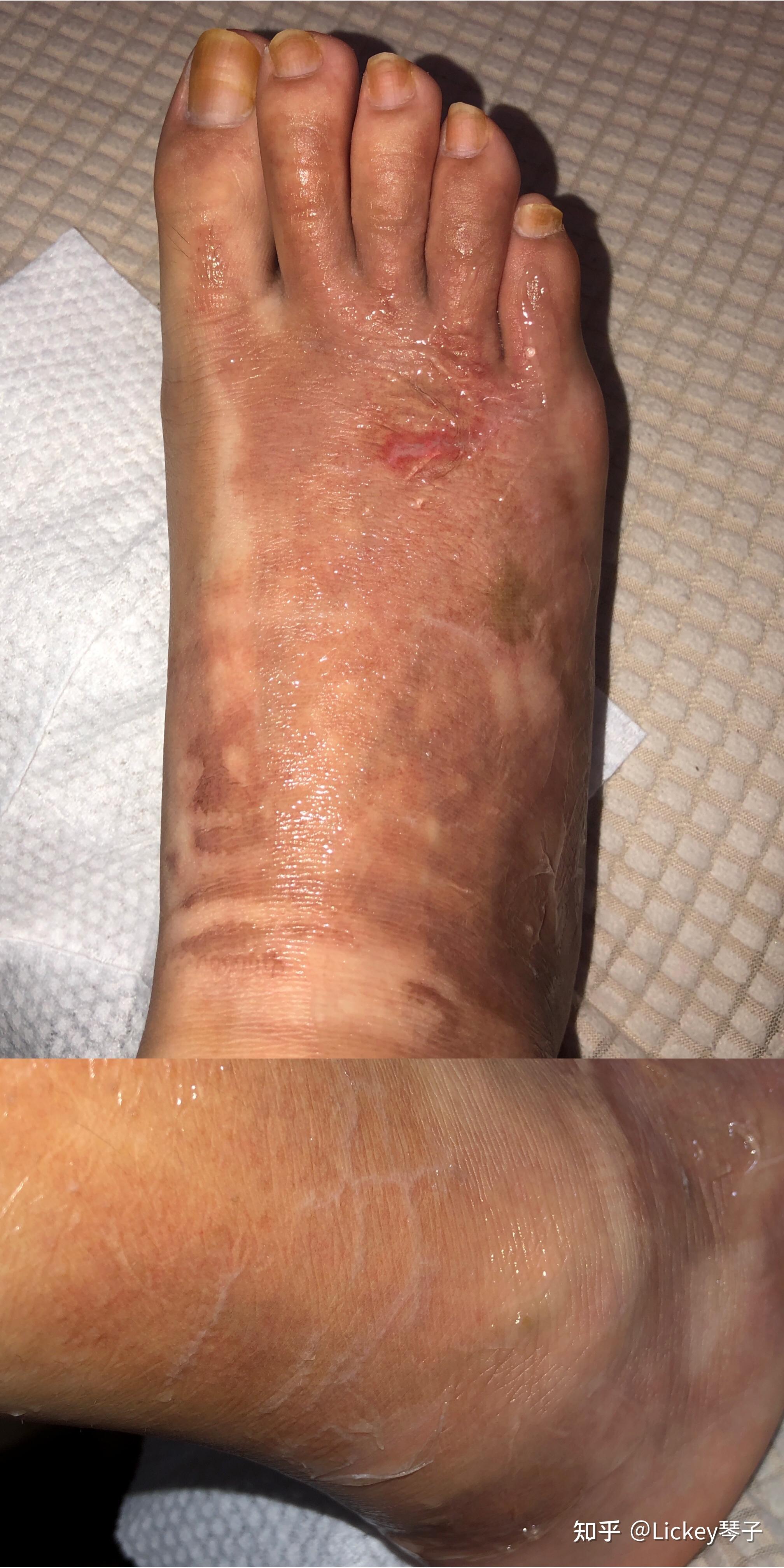 小腿意外烫伤,心理接受不了怎么办? - 知乎