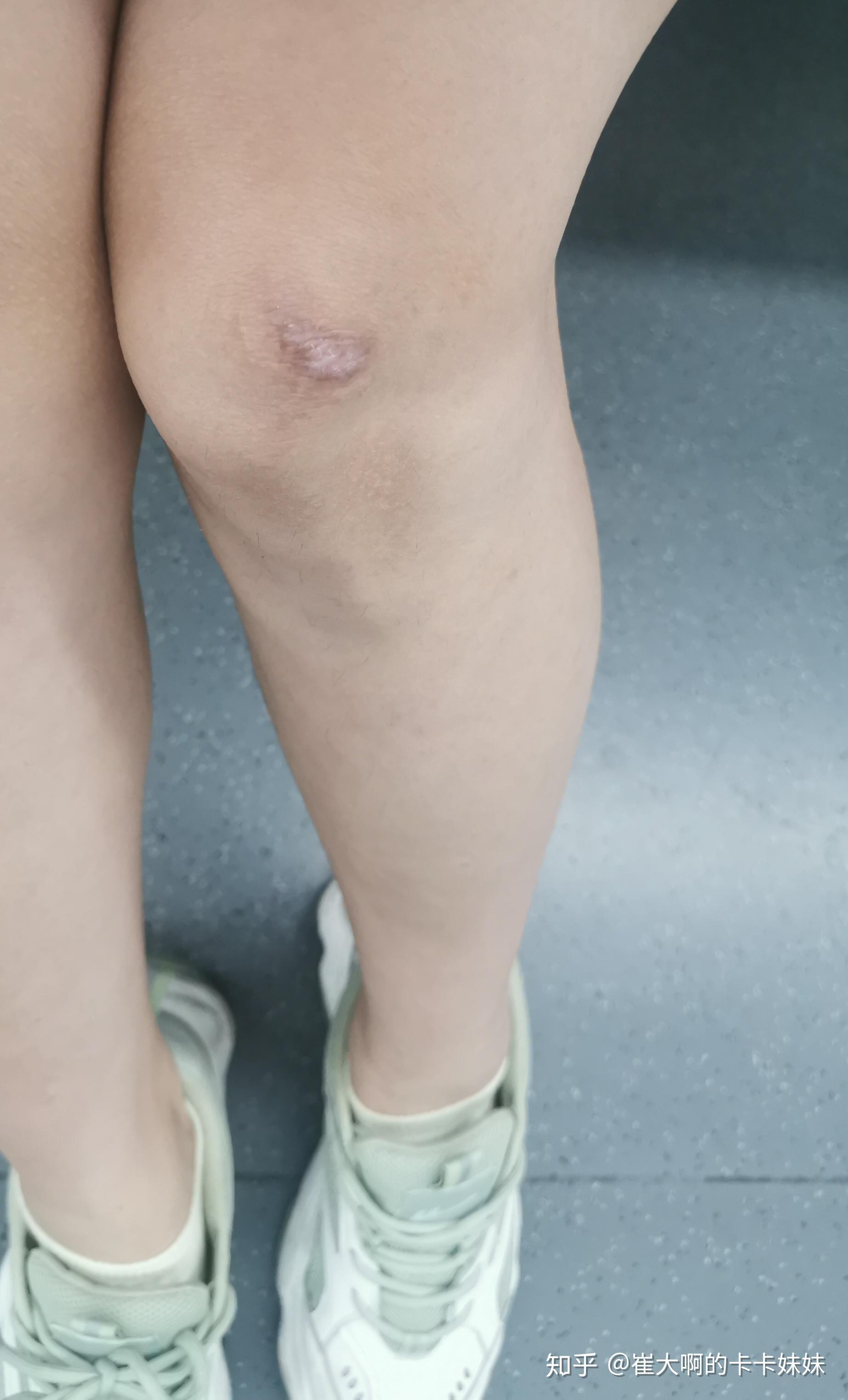 骑车侧翻膝盖摔伤破皮,怎么处理伤口,怎样才能不留疤? - 知乎