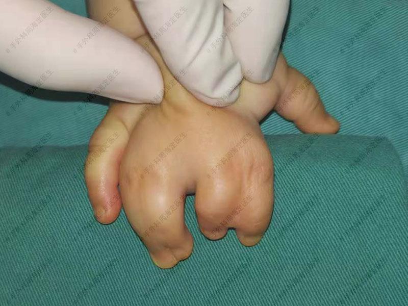 孩子先天性并指畸形手术需要分几次做