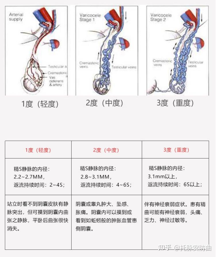 精索静脉曲张重度图片