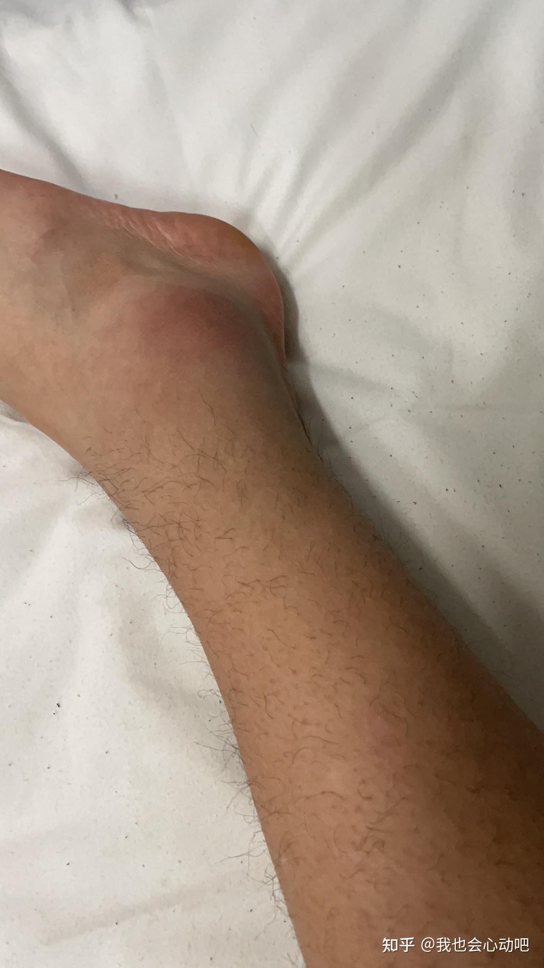 脚崴了肿了如果不及时处理会怎样