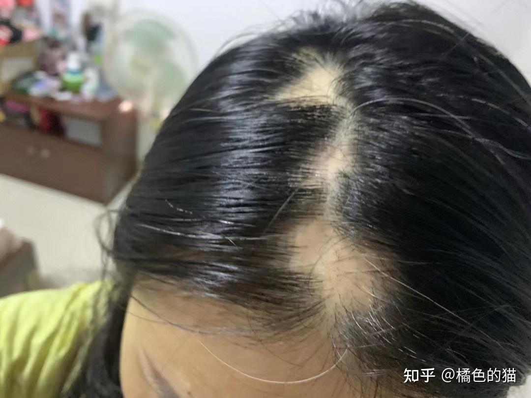斑秃是个什么情况造成的,可以治好吗? - 知乎