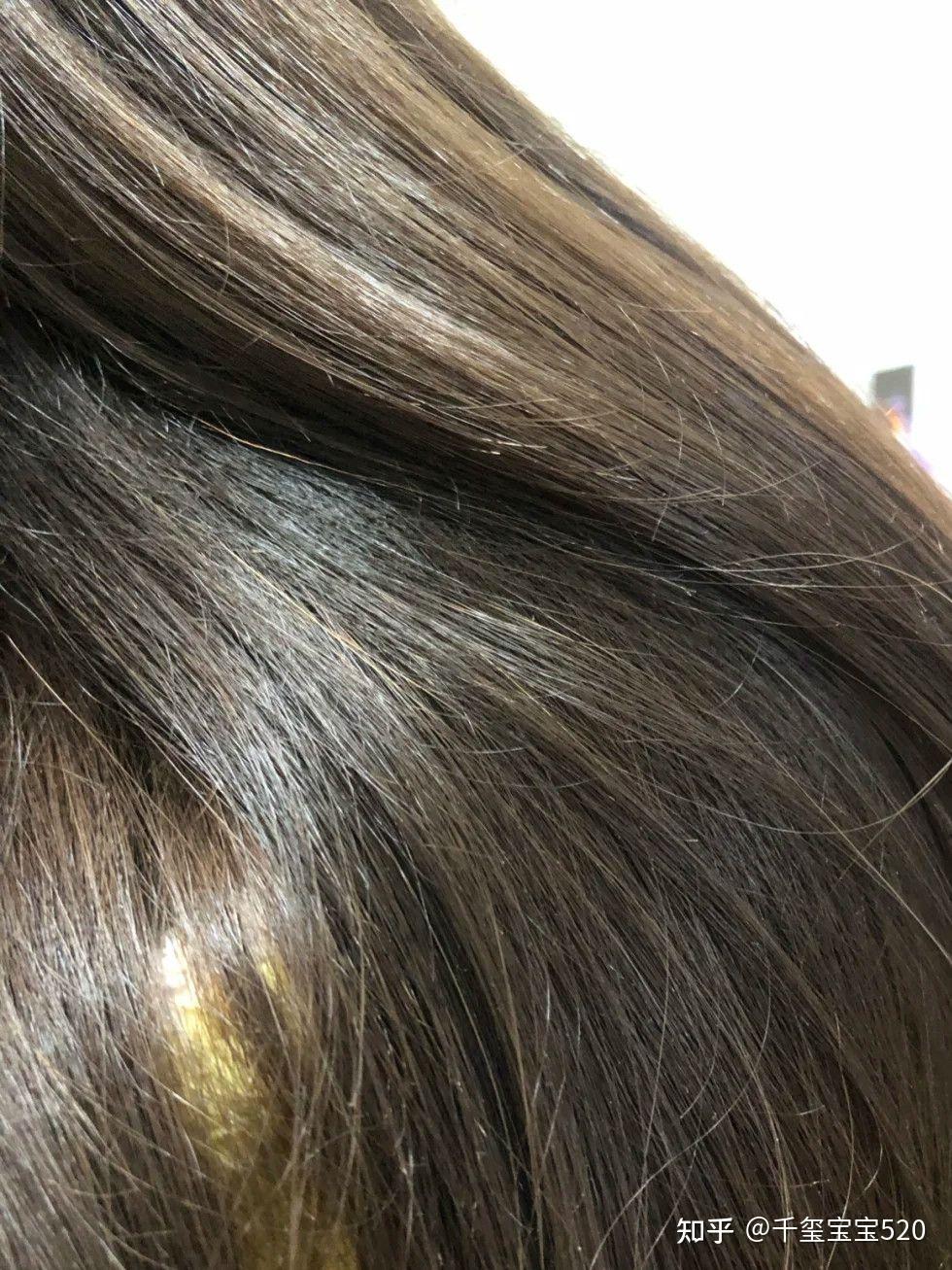 怎样治疗头部脂溢性皮炎(脂溢性脱发头发还能长回来吗)