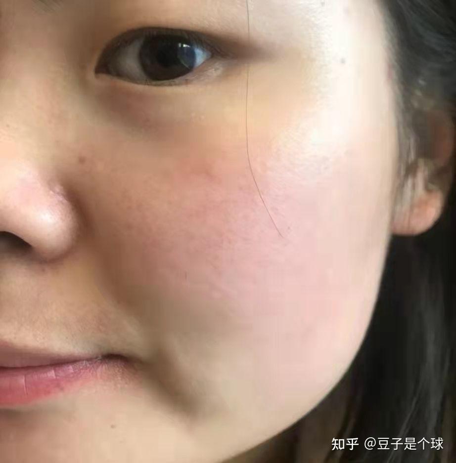 敏感肌脸泛红的你们用过超好用的护肤品是什么? - 知乎
