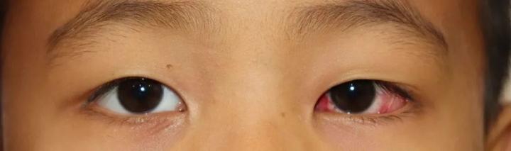 6月3日著名斜弱视专家郭新教授亲临西安会诊及手术,名额有限!