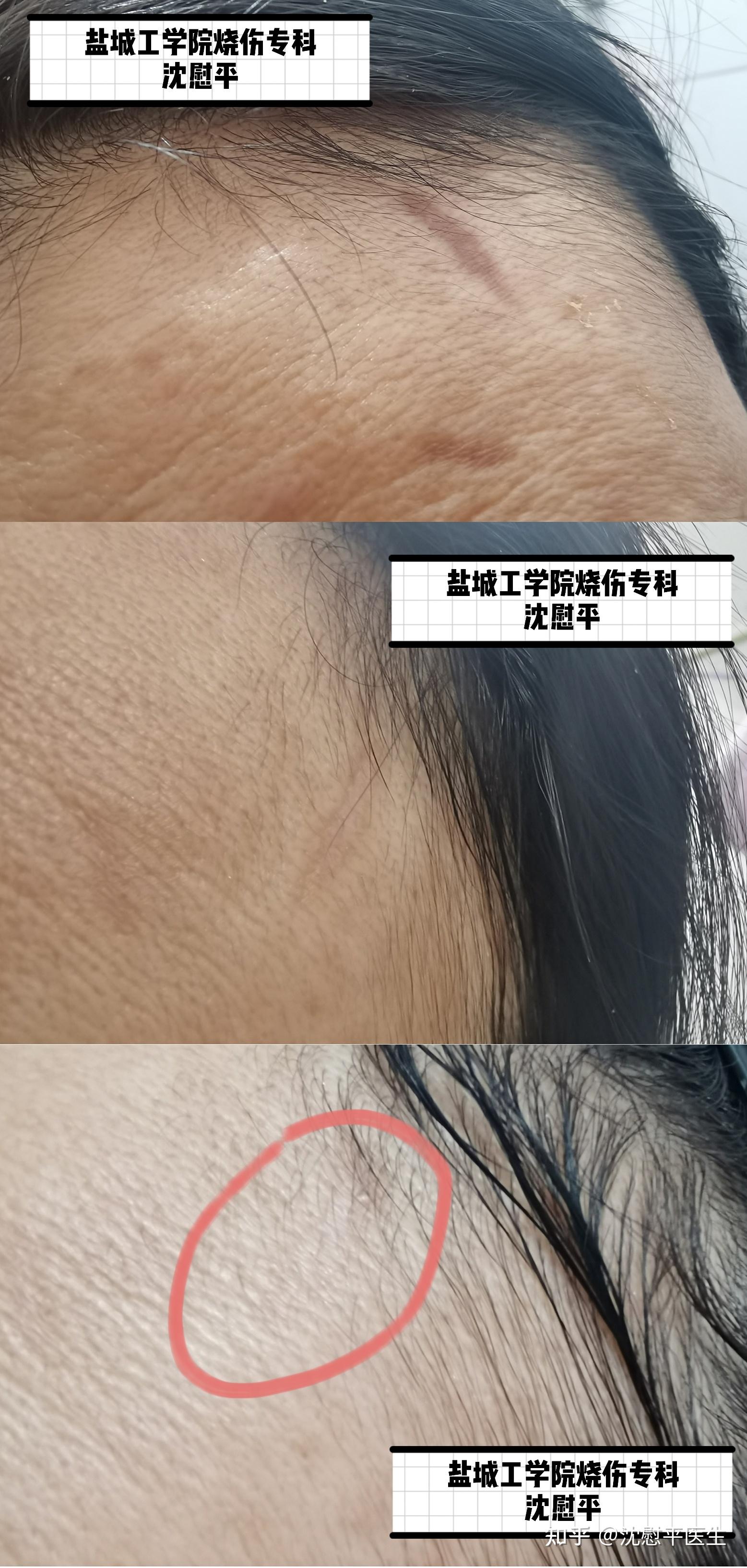 烧伤的伤疤能彻底去除吗?如何祛除? - 知乎