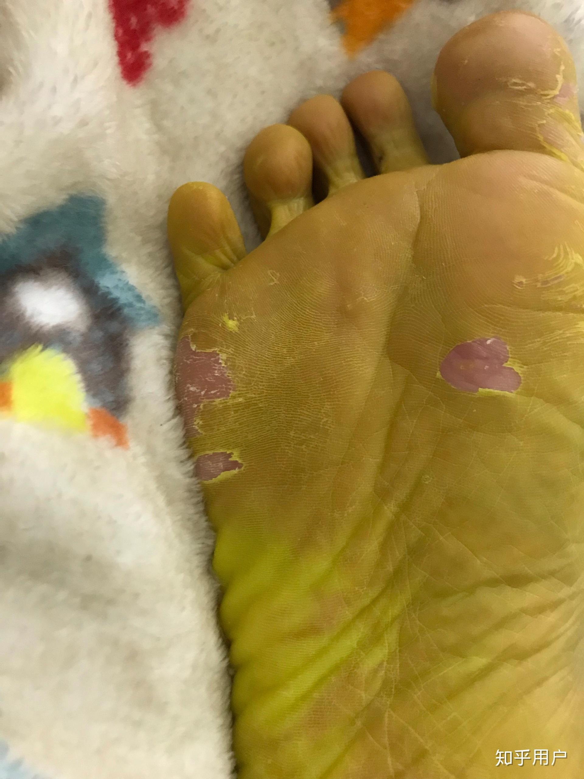珊瑚癣净管用吗