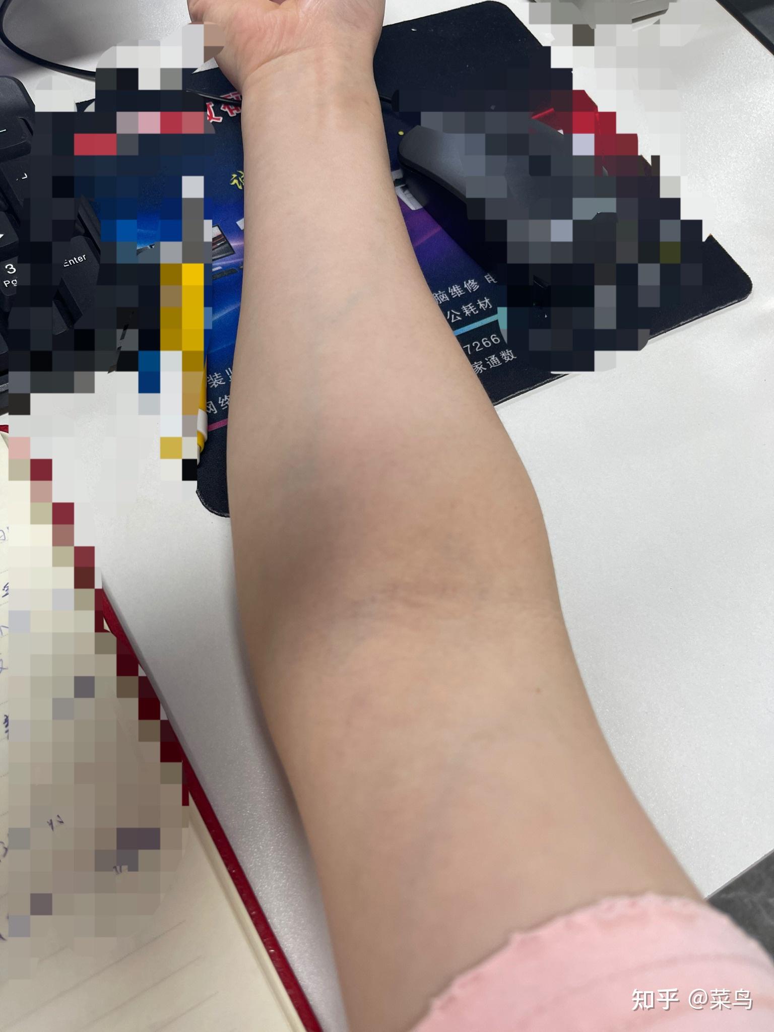 为什么我的手背上静脉血管那么明显?如何改善?