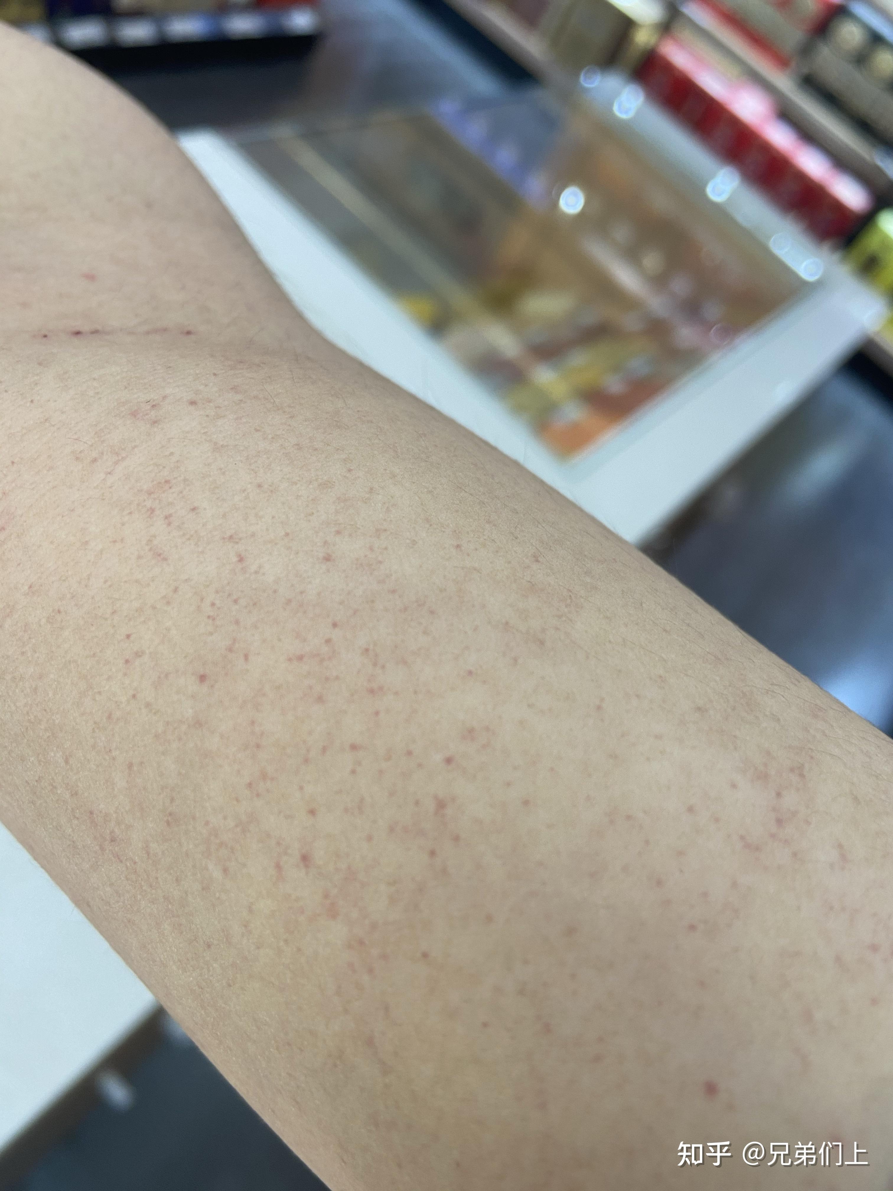 喝酒身上起红点就这一个胳膊