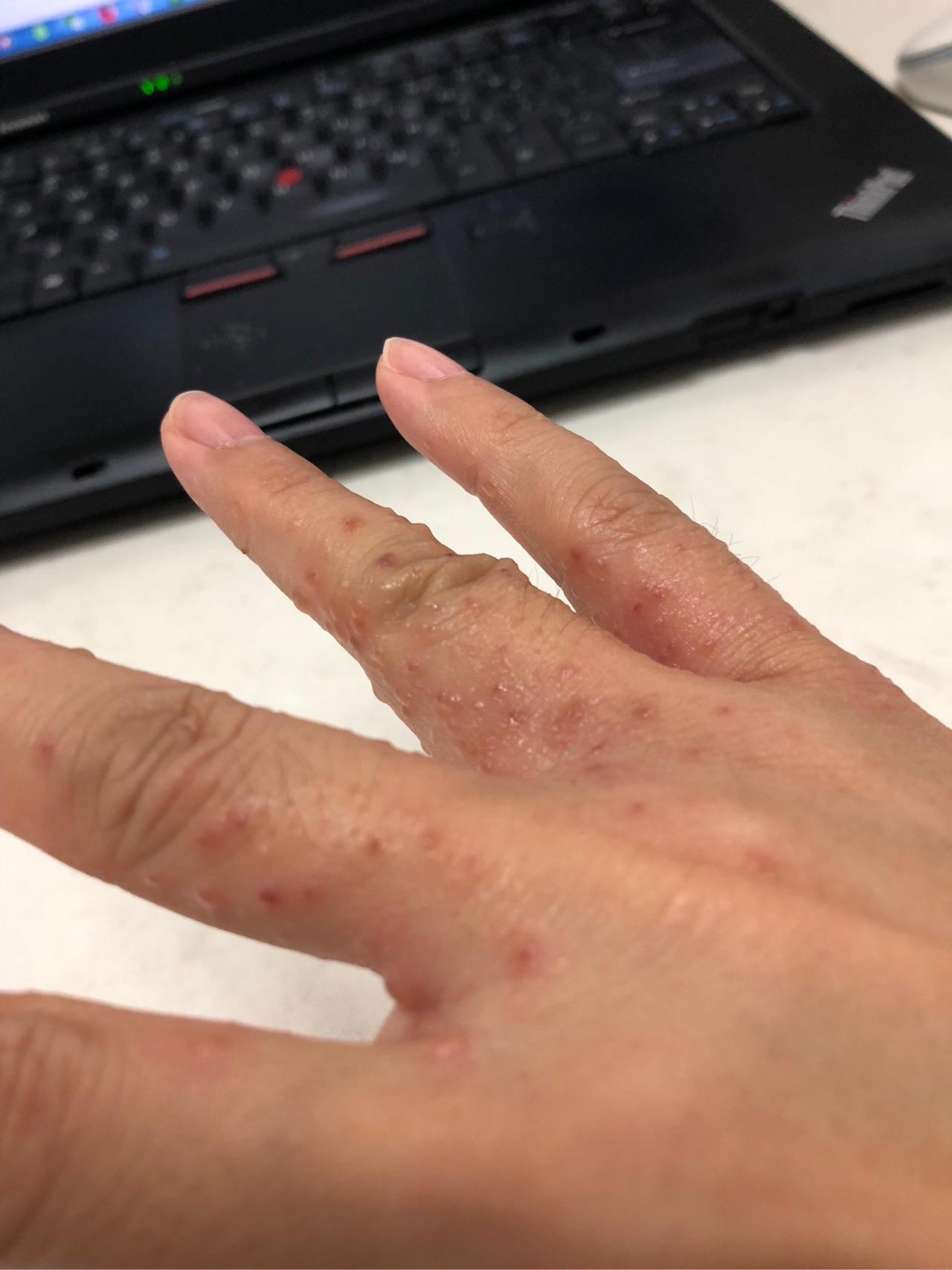 汗疱疹的病因是什么是真菌感染吗