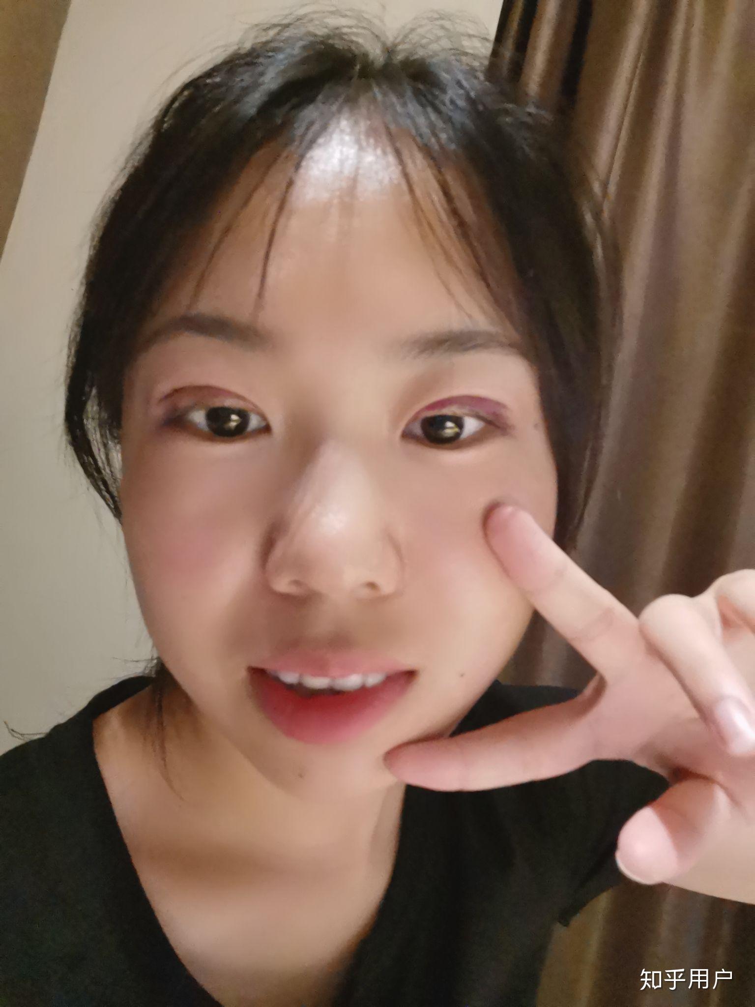 全切双眼皮6.5mm会不会很窄? - 知乎