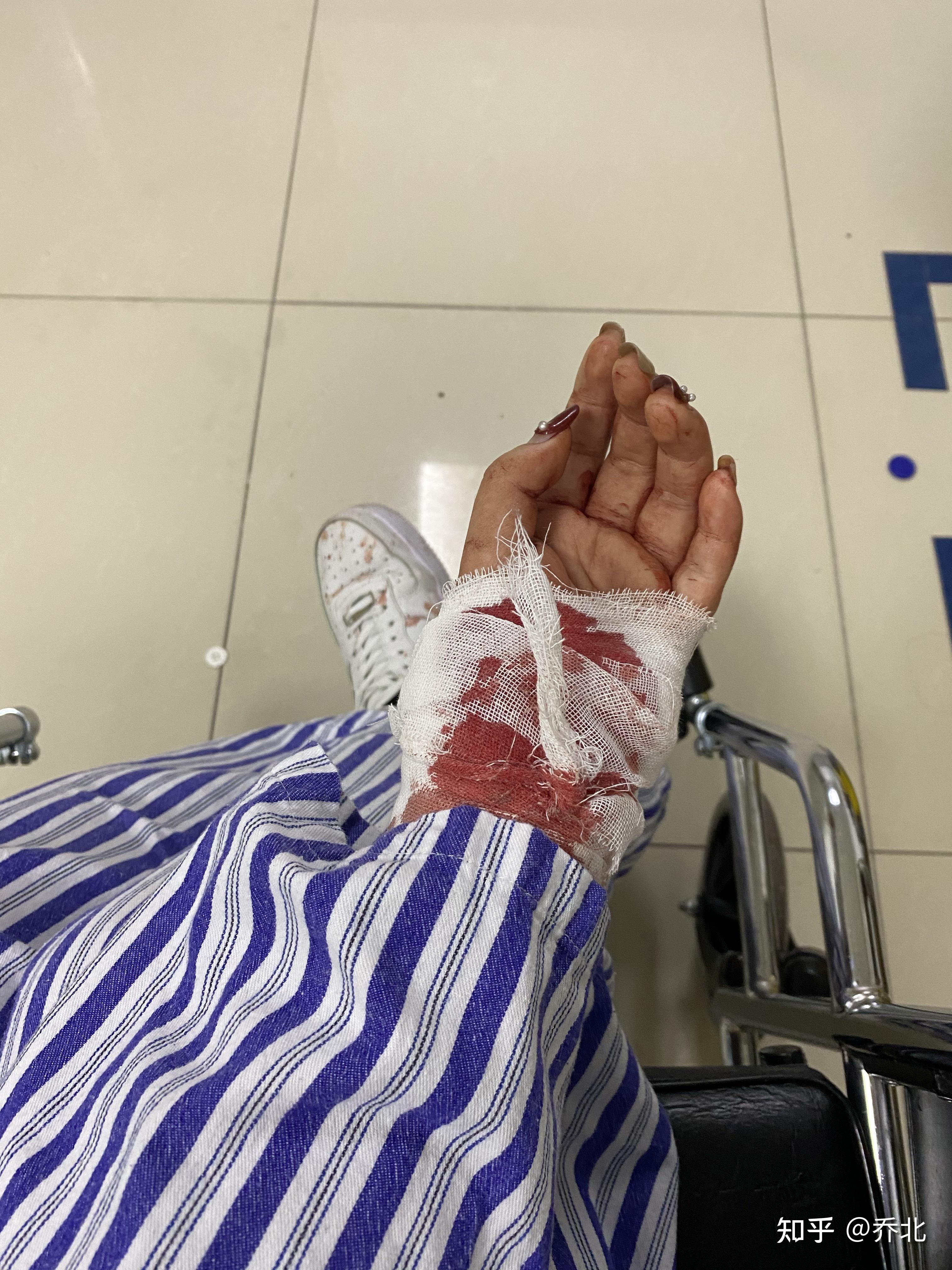 手被刀划伤得一瞬间是什么感觉? - 知乎