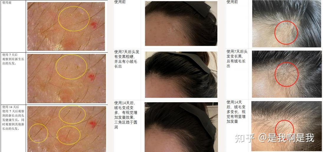从“地中海”变身“发量王者”,全靠中科院博士推荐的防脱育发液,实测30天发量翻倍,改善狂掉发、头顶秃! - 知乎