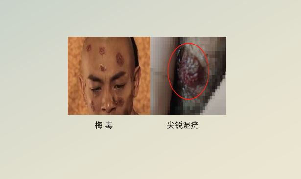花柳病是什么症状 常见花柳病图片主要有哪几种 知乎 花柳病是什么症状 常见花柳病图片主要有哪几种 知乎