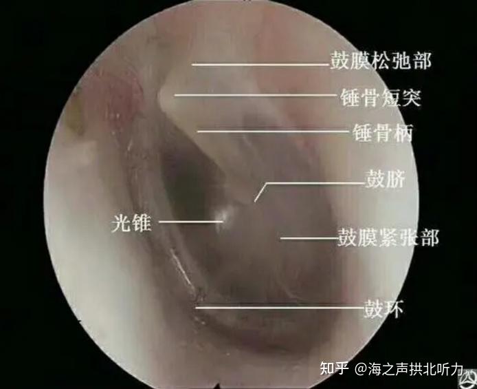 耳膜穿孔會自愈嗎