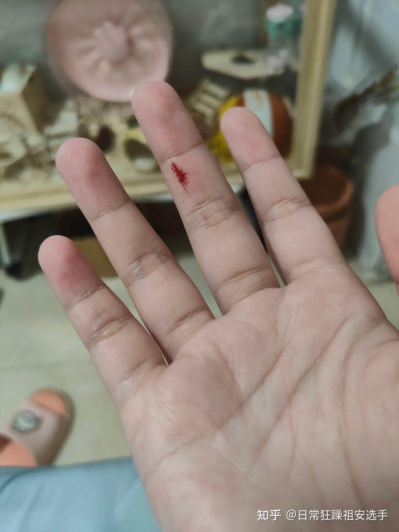 被金丝熊咬出血了怎么办?