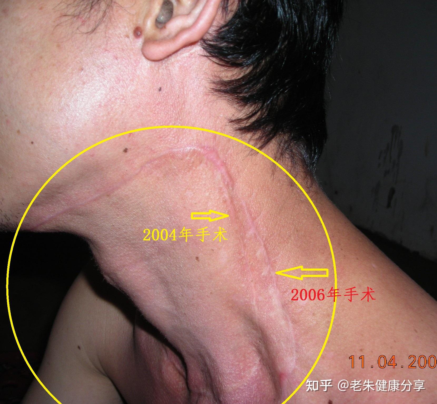 甲状腺癌可以治愈吗?