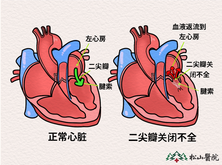 二尖瓣位于图片
