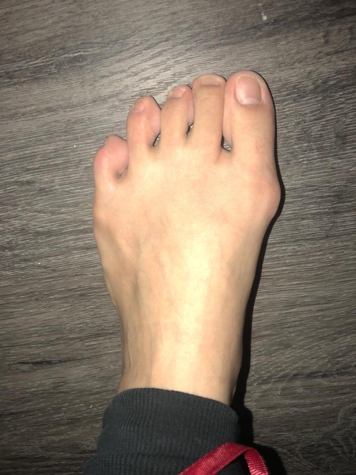 作为一个女生脚拇指外翻是一种怎样的体验