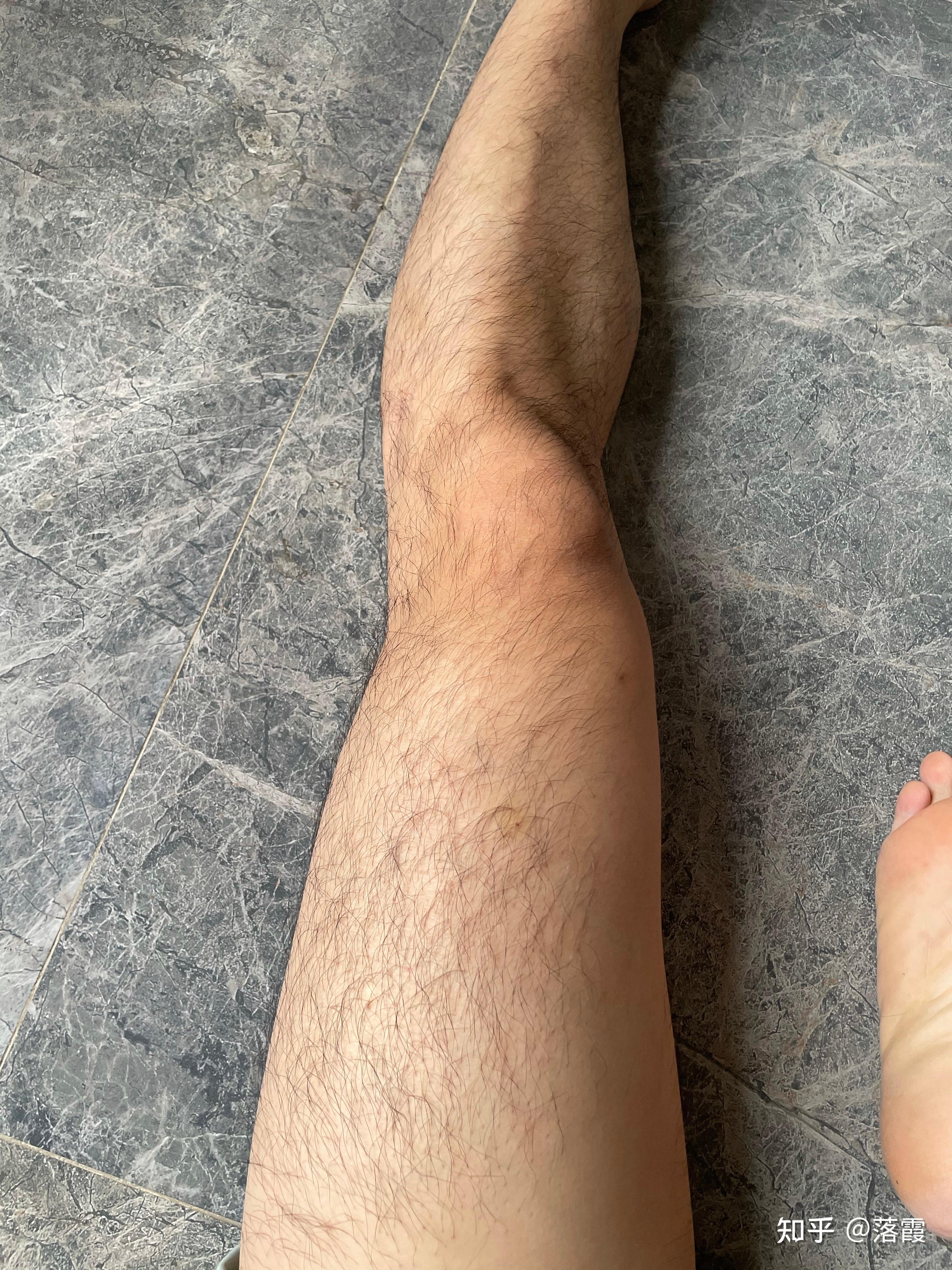 男生腿毛浓密怎么办