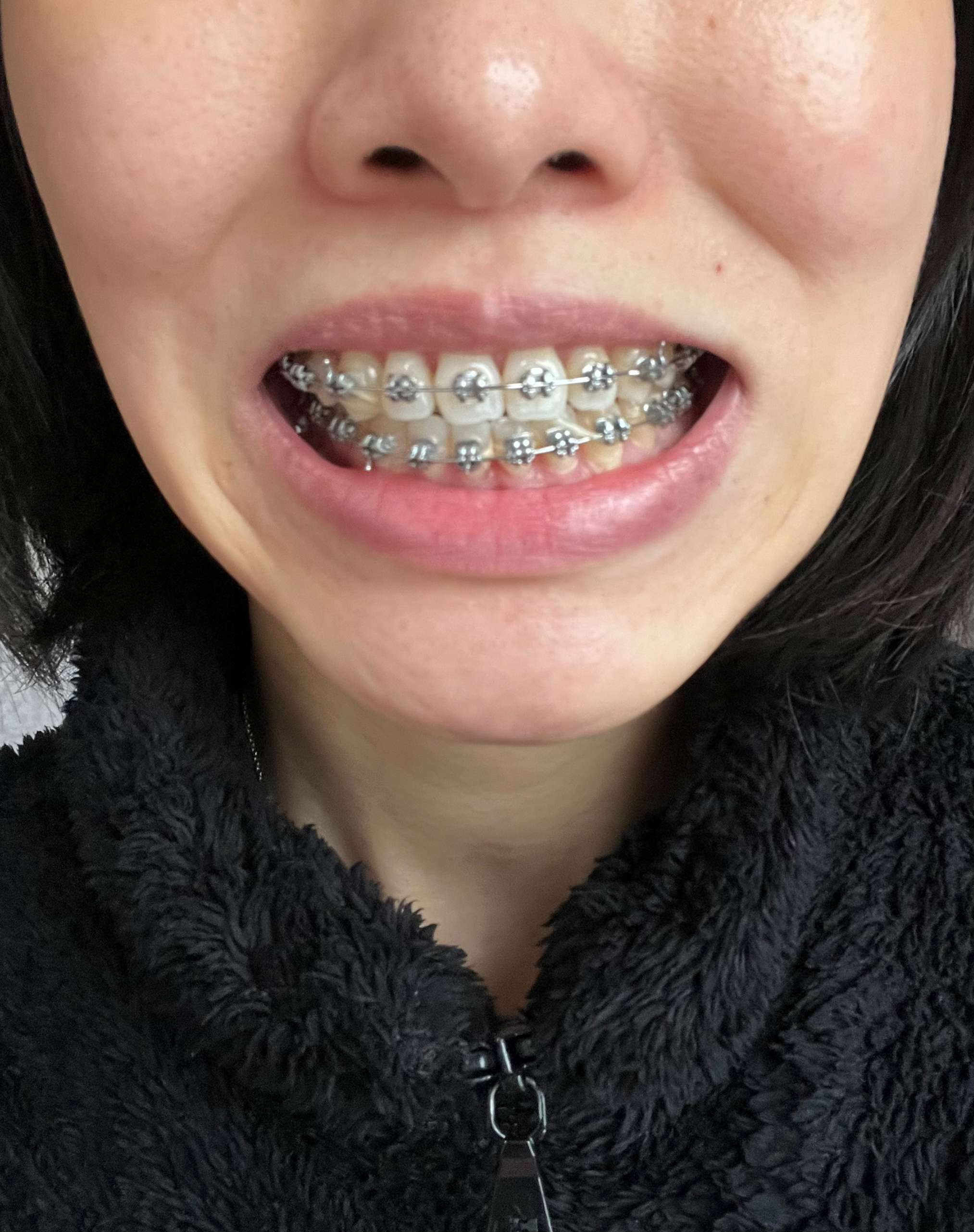 严重偏颌,两位医生给了两套方案,不知道该做怎样的选择? - 知乎