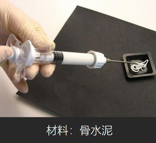 骨水泥填充具体是怎么操作的?查看手术原理会不会导致脱发?