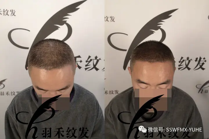 植发和纹发有着怎样的紧密联系? - 知乎