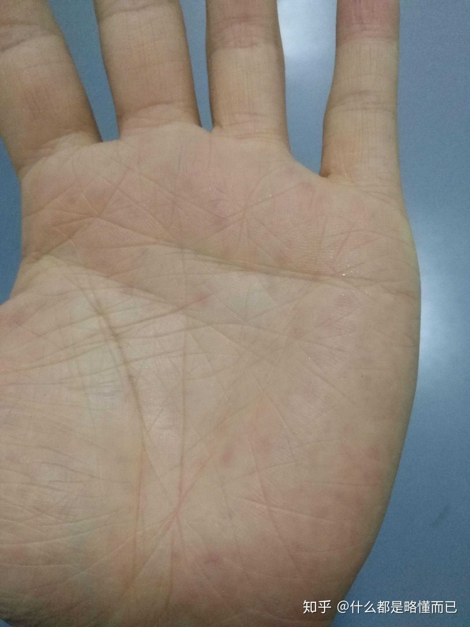 手掌出汗严重,死皮,长了好多红点,有的时候很痒,药店的人说是湿疹,体