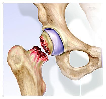 做好这几件事降低外伤性股骨头坏死的发病几率