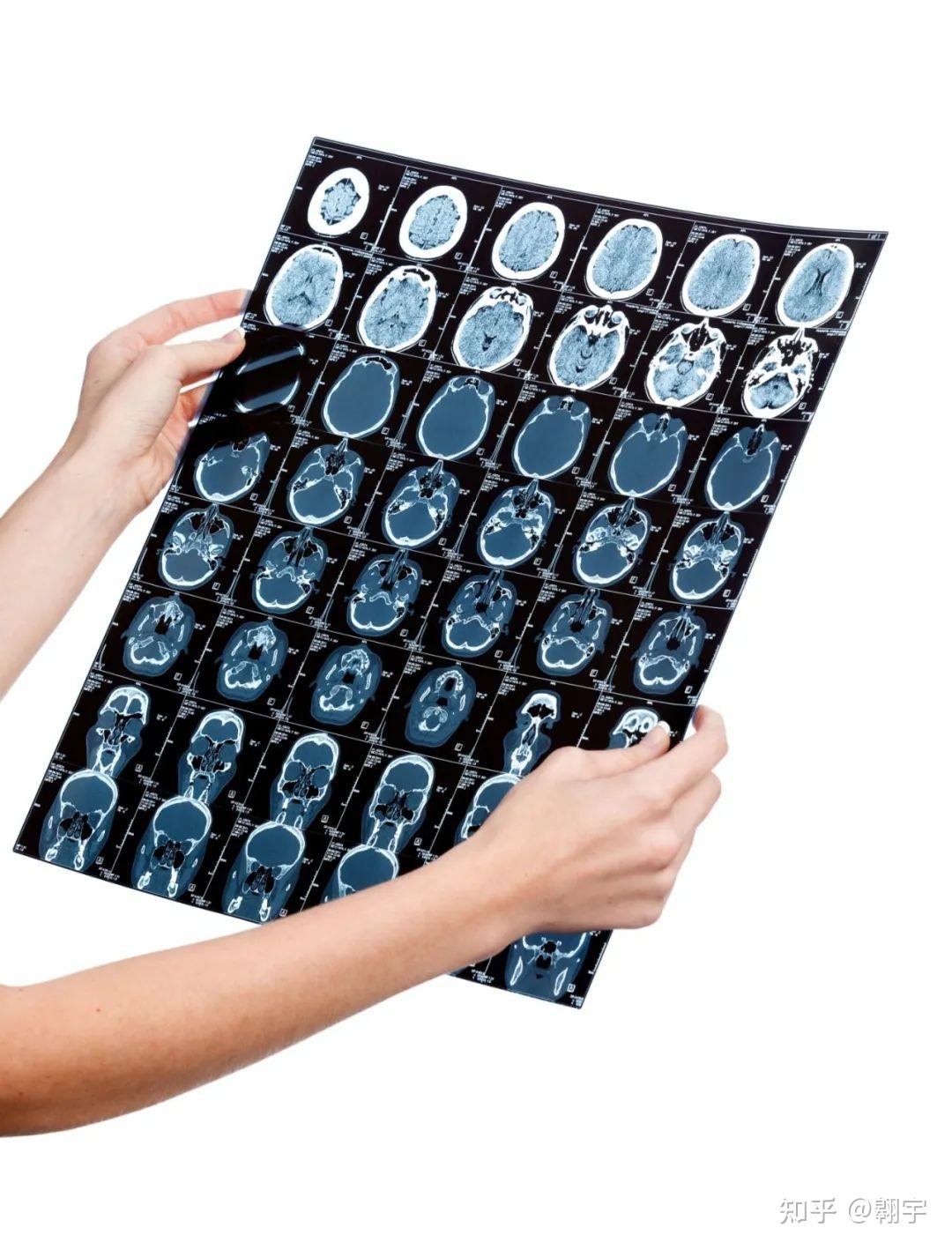 脑转咋办?6项研究发现肺癌EGFR靶向药搭配抗血管生成靶向药疗效更好,活得更长! - 知乎