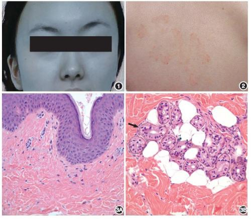 血色素沉着症与糖尿病有什么必然的联系