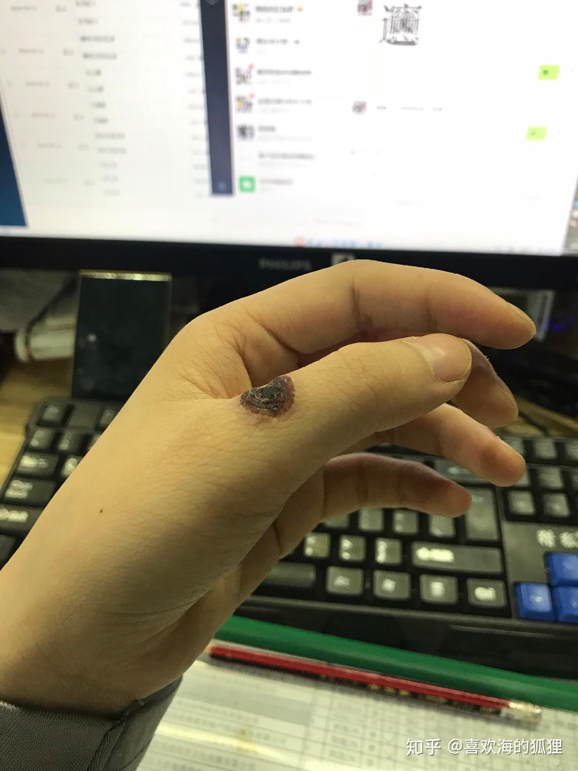 手上长了个小肉球,不知道该肿么办 求大神帮忙! - 知乎