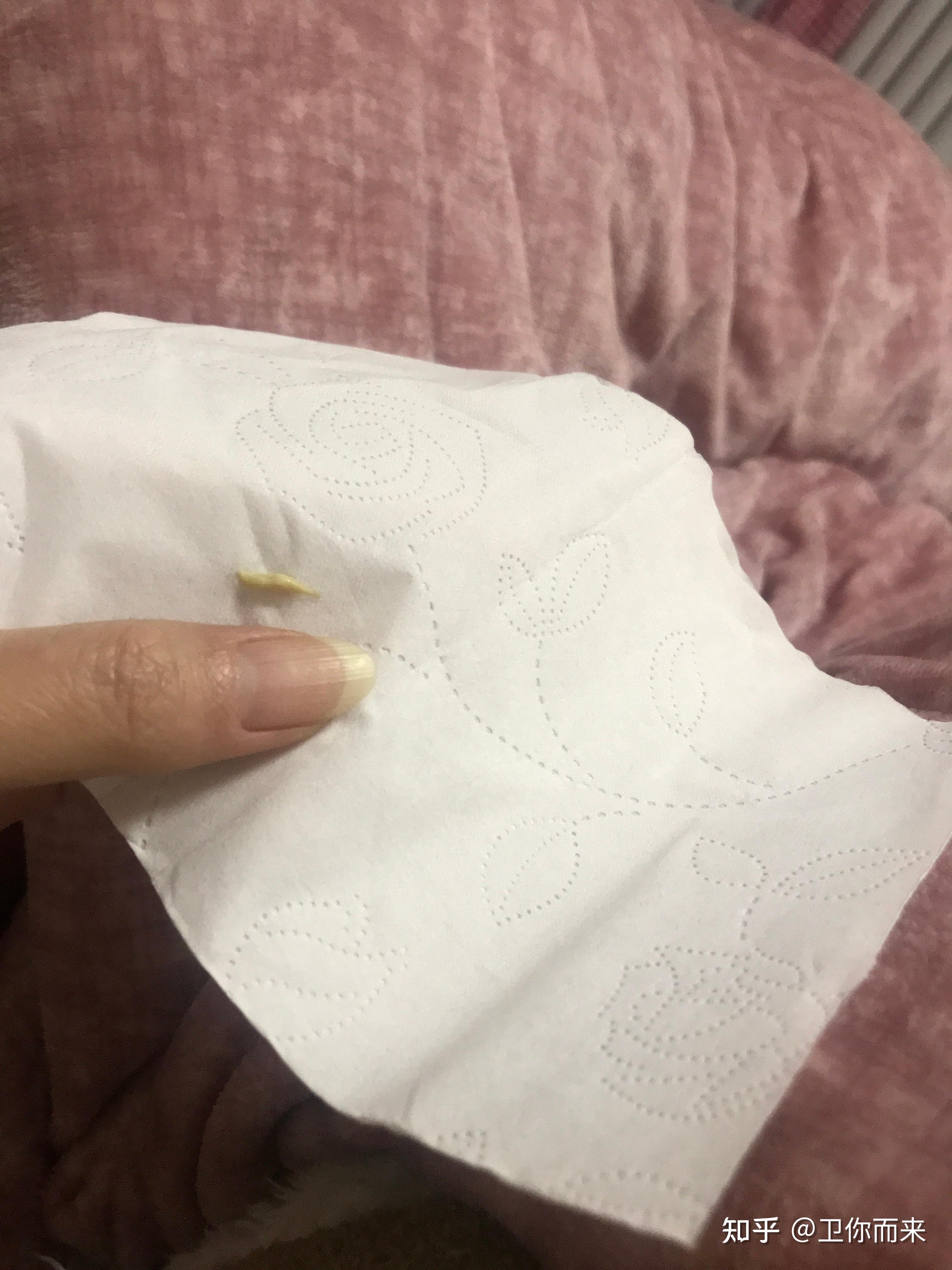 扁桃体结石如果不人为清除它自己会脱落吗