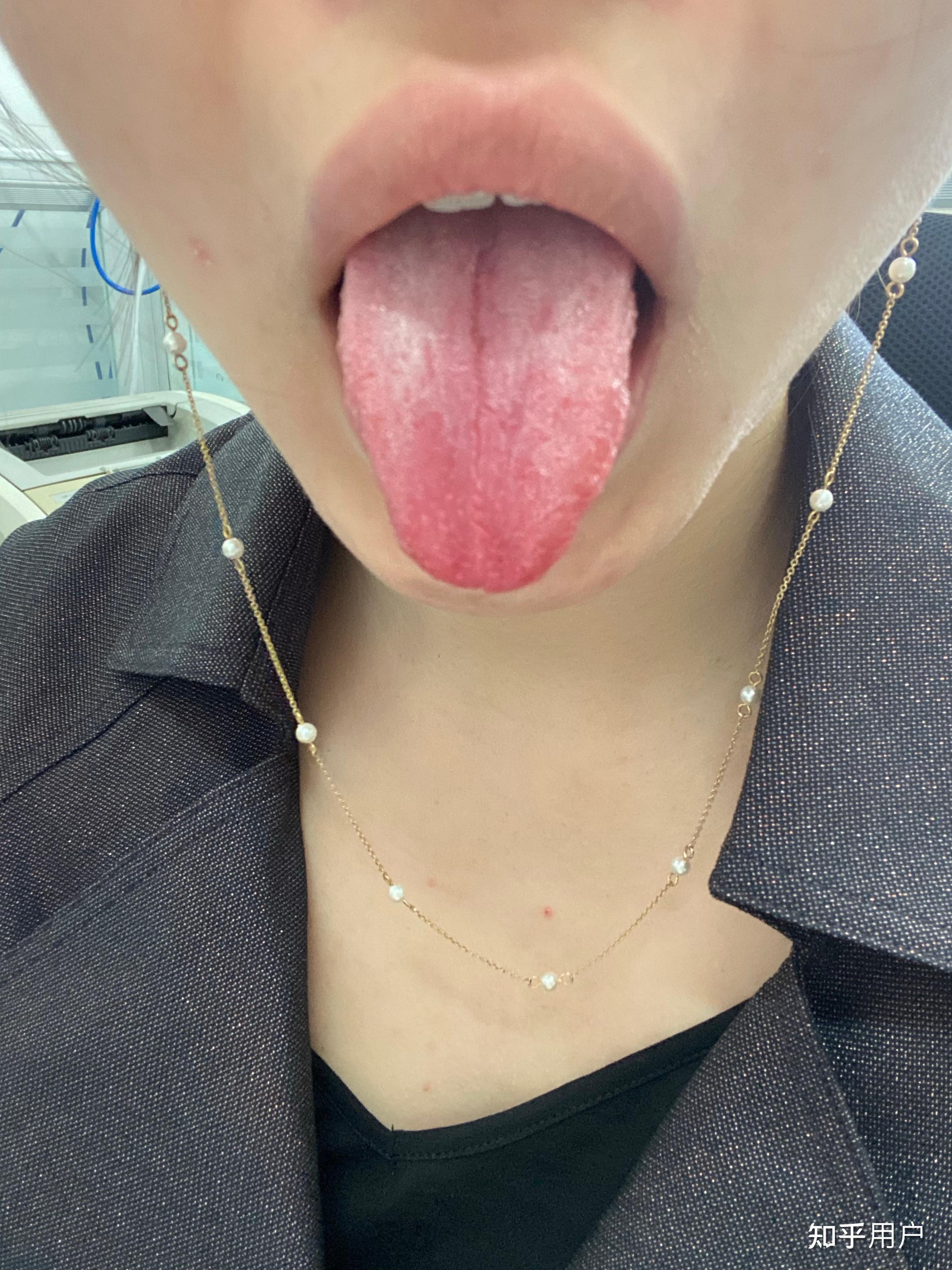地图舌需不需要治疗? - 知乎
